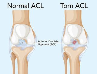 Anatomical illustration of a torn ACL in the knee, highlighting the ligament injury treated with rehabilitation physiotherapy