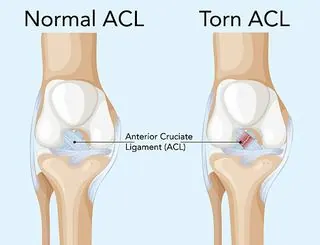 Anatomical illustration of a torn ACL in the knee, highlighting the ligament injury treated with rehabilitation physiotherapy