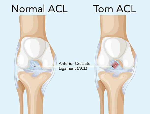 Anatomical illustration comparing a healthy ACL to a torn ACL in the knee, showing the injury addressed across the phases of reconstruction recovery