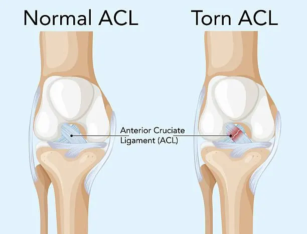 Anatomical illustration of a torn ACL in the knee, highlighting the ligament injury treated with rehabilitation physiotherapy