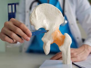 Illustration of hip replacement surgery and joint arthroplasty relevant to recovering at home