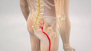 3D render of a pinched sciatic nerve showing the nerve compression treated with physiotherapy