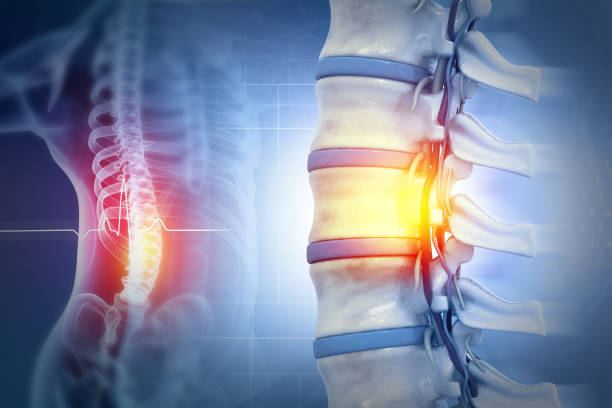 3D illustration of the spinal cord and vertebrae highlighting recovery after spinal surgery
